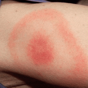 image of tick bite possibly indicating Lyme disease